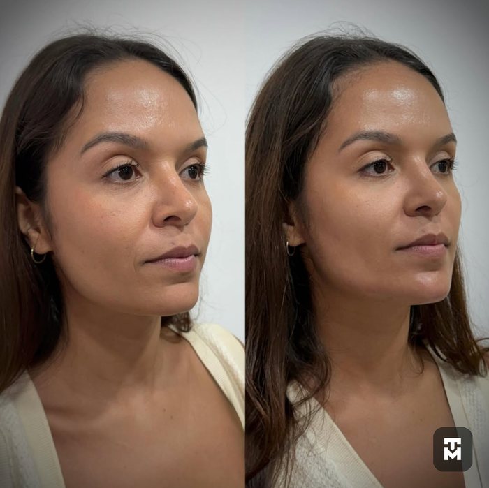 Resultado de procedimento facial, antes e depois — ampliar imagem