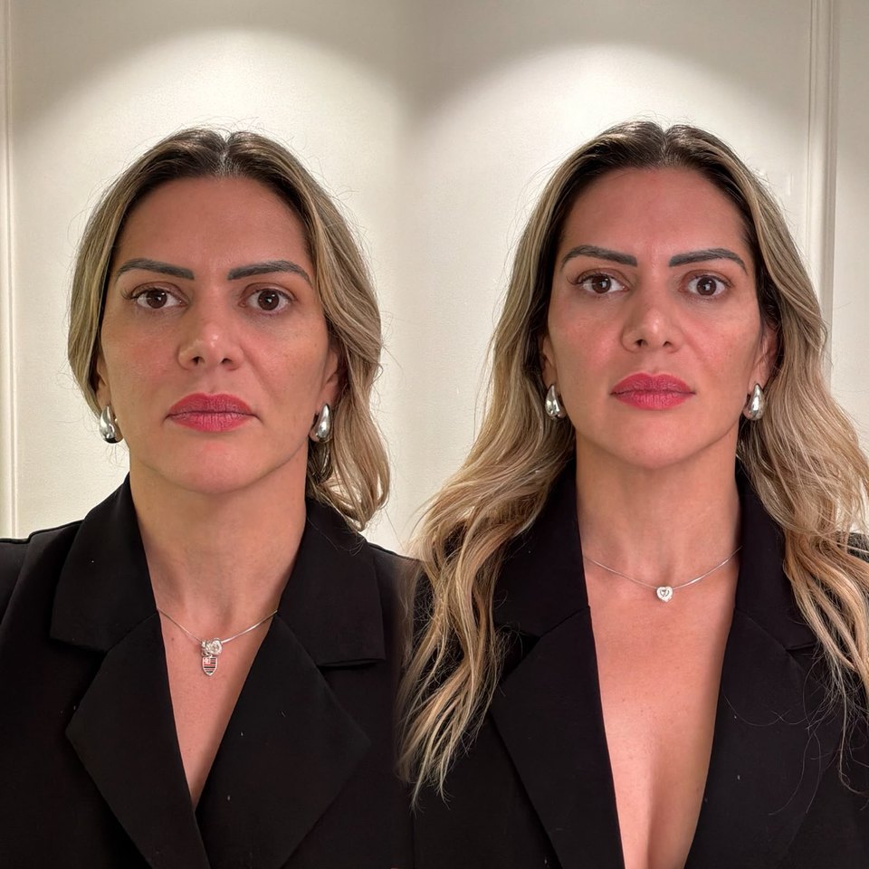 Comparativo autorizado de resultado estético facial, imagem 10 de 13