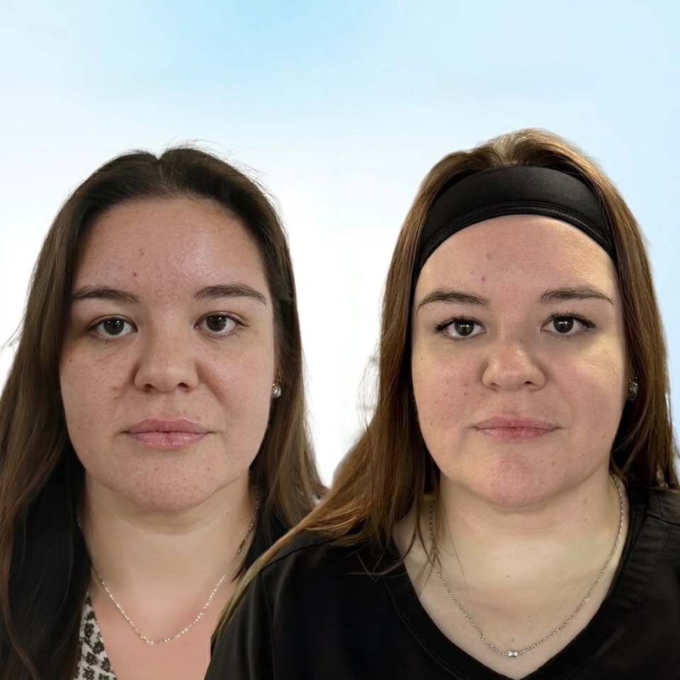 Comparativo autorizado de resultado estético facial, imagem 12 de 13