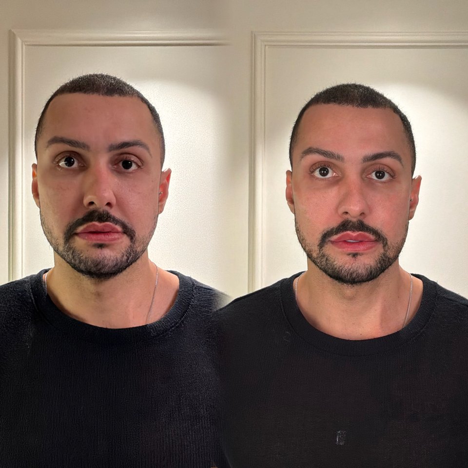 Comparativo autorizado de resultado estético facial, imagem 13 de 13